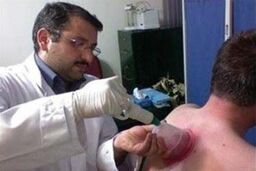 بایدها و نبایدهای حجامت