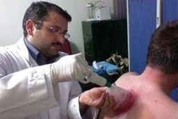بایدها و نبایدهای حجامت