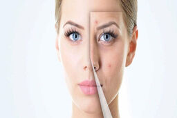 پاک شدن جای جوش با چند ترفند حرفه ای + معرفی 4 ماده در دسترس دشمن جوش