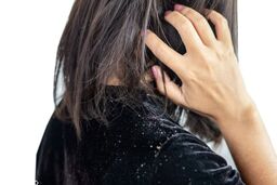 درمان خانگی شوره سر با روش های طبیعی