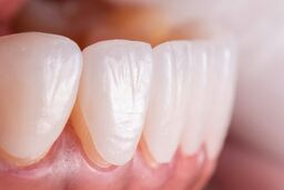 چگونه عمر لمینت دندان هایتان را افزایش بدهید؟