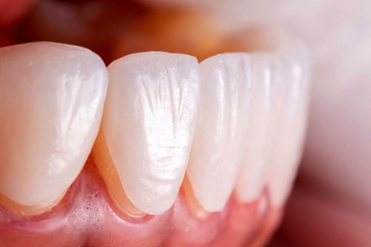 چگونه عمر لمینت دندان هایتان را افزایش بدهید؟