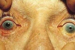 ۸۰۰ هزار ایرانی به آب سیاه مبتلا هستند + توصیه ها