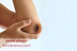 ترفندهایی برای سفید کردن نقاط تیره بدن