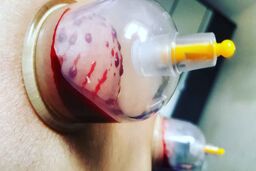 از بهترین روزهای حجامت در پاییز غافل نشید + شرایط و نکات تغذیه ای