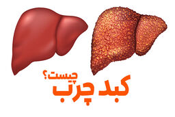 درمان خانگی  کبد چرب