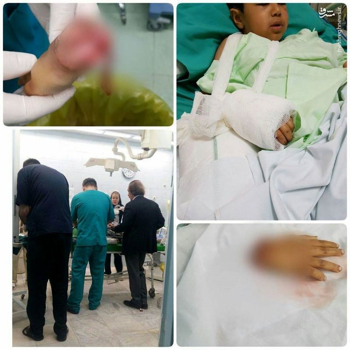 پیوند دست قطعشده کودک زلزلهزده